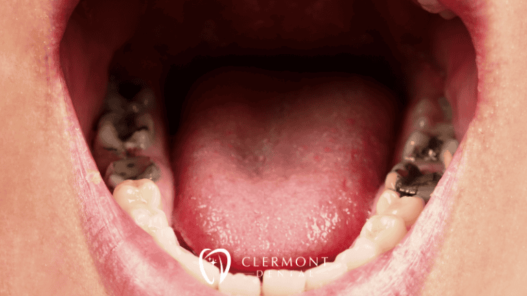BLOG Images Clermont Dental (10)