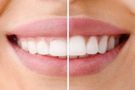 gum treatment