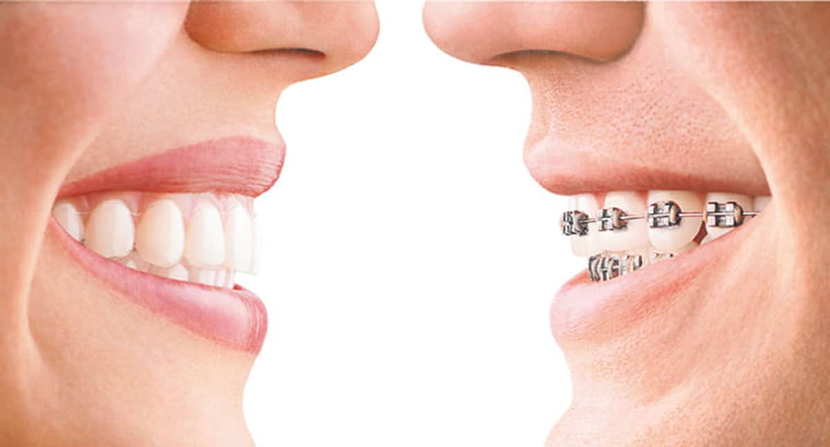 Invisalign Vs Braces: Advantages of Invisalign
