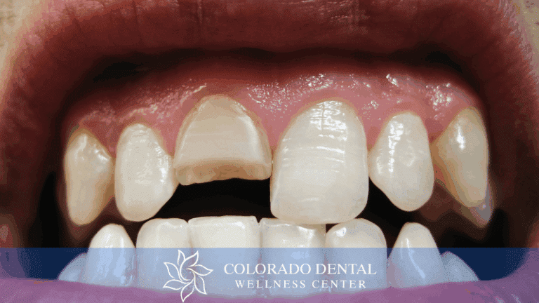 Cracked Tooth_ Restorative Solutions to Save Your Smile