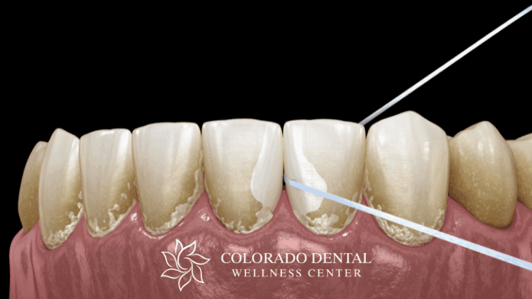Plaque Build-Up vs