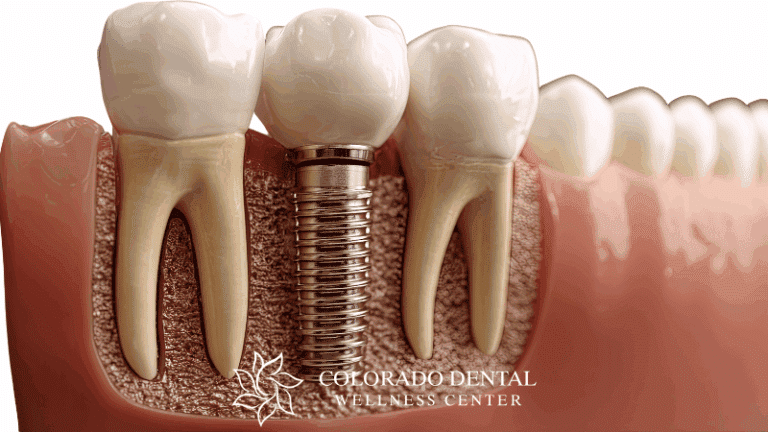 Restoring Your Smile_ Understanding Dental Implants and Bridges