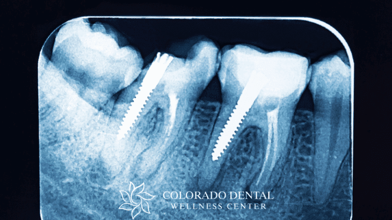The Importance of Prompt Emergency Dental Care_ Preventing Further Complications