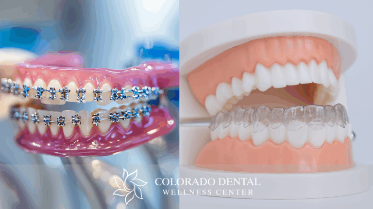 Clear Aligners vs