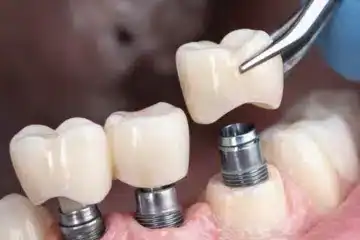 Implant-Supported Crowns and Bridges Images