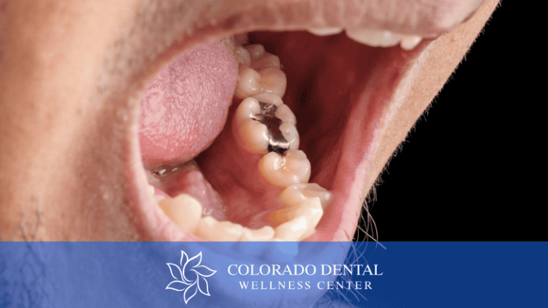 Toxic Mercury Amalgam Fillings